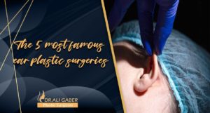 Read more about the article The 5 most famous ear plastic surgeries