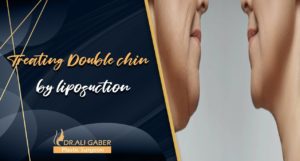 Read more about the article Treating Double chin by liposuction