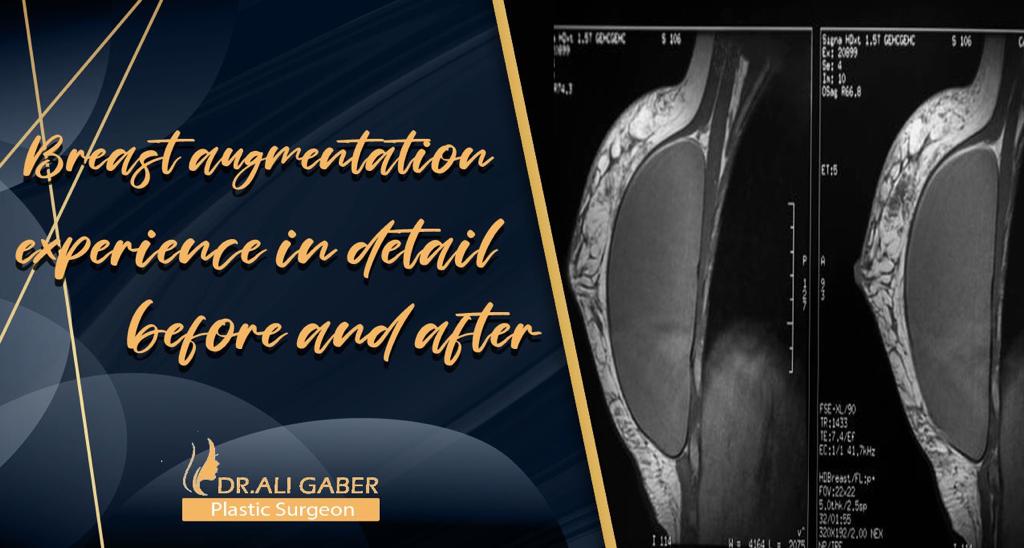 You are currently viewing Breast augmentation experience in detail before and after