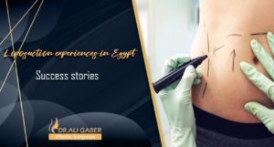 Read more about the article Liposuction experiences in Egypt | Success stories