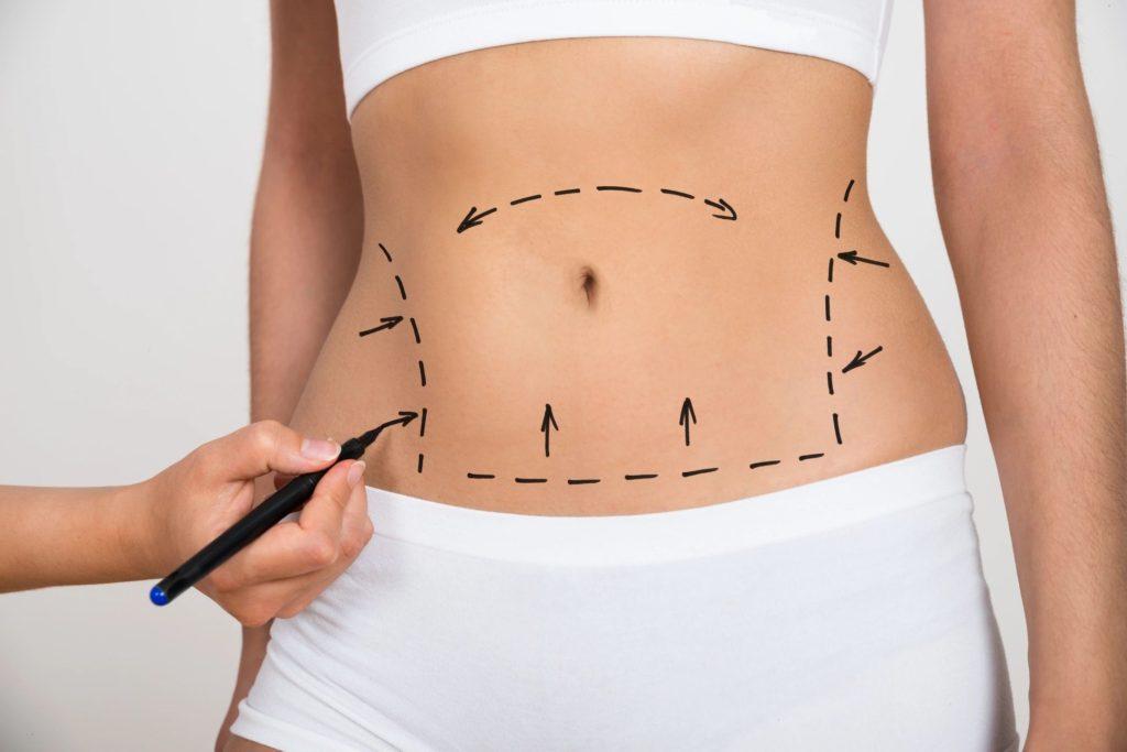 liposuction devices