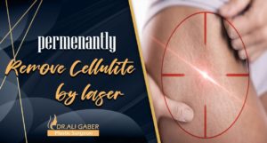 Read more about the article Permanently remove cellulite by laser and get rid of white threads