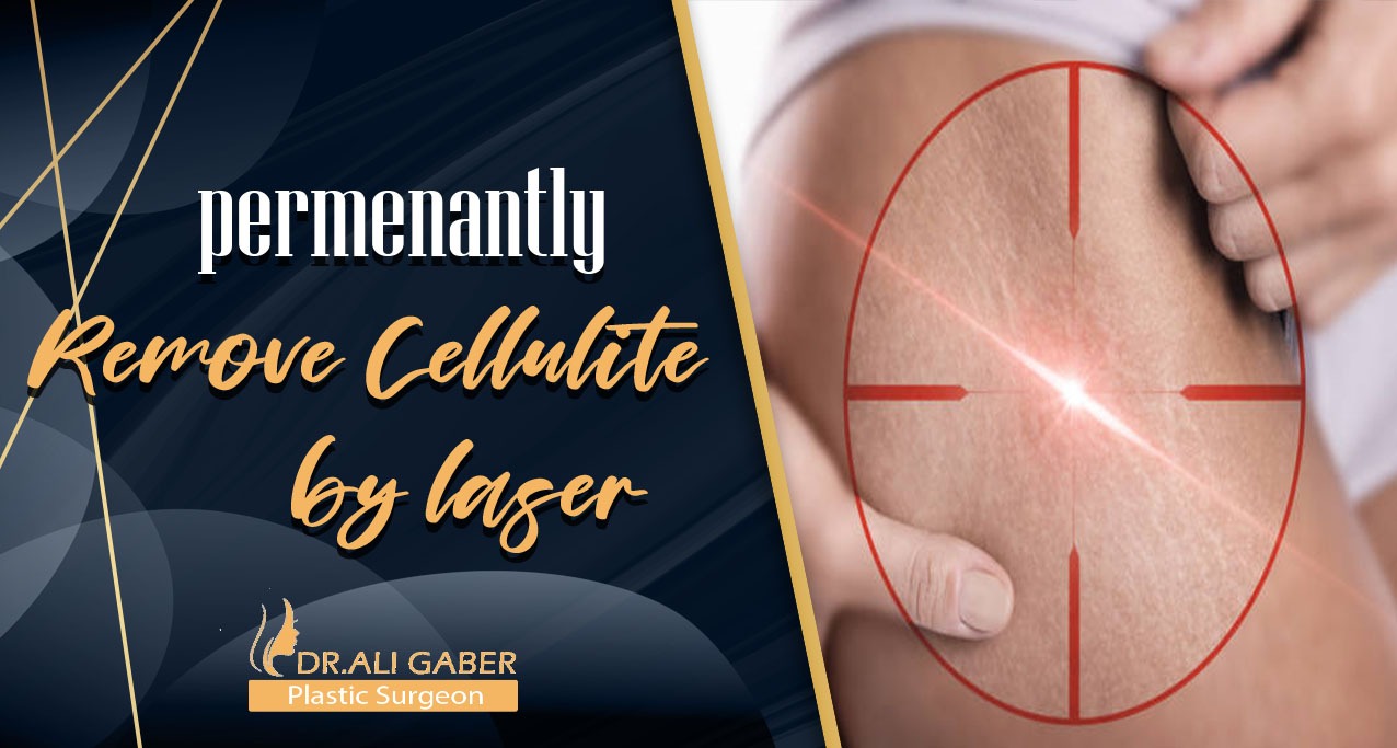 You are currently viewing Permanently remove cellulite by laser and get rid of white threads