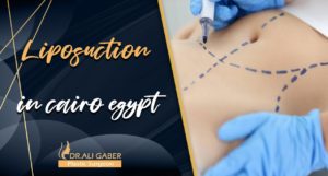 Read more about the article Liposuction in Cairo Egypt: Advantages and disadvantages