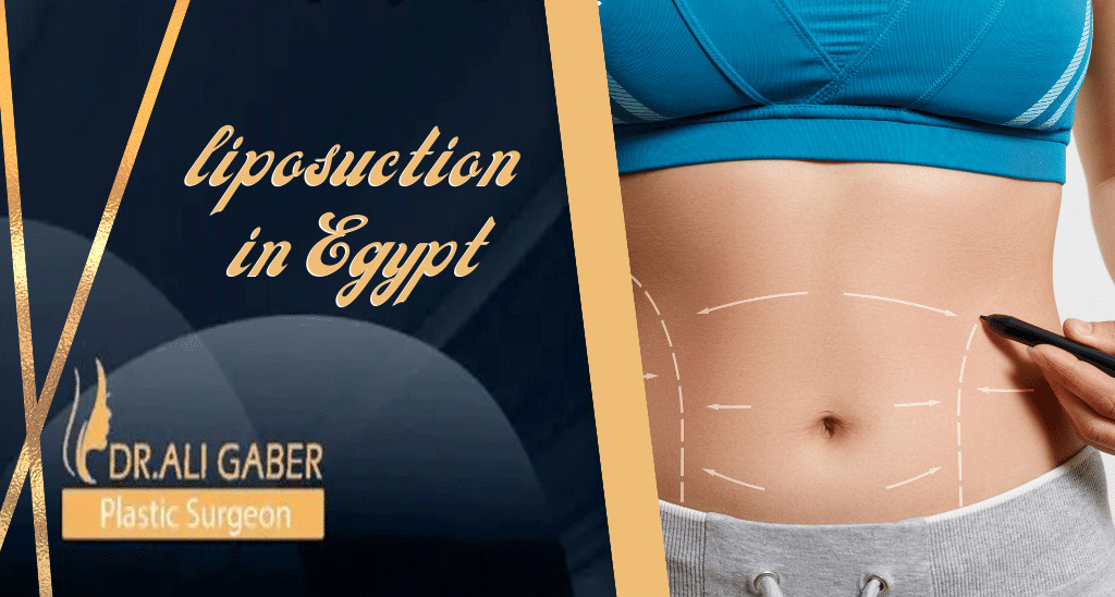You are currently viewing liposuction in Egypt