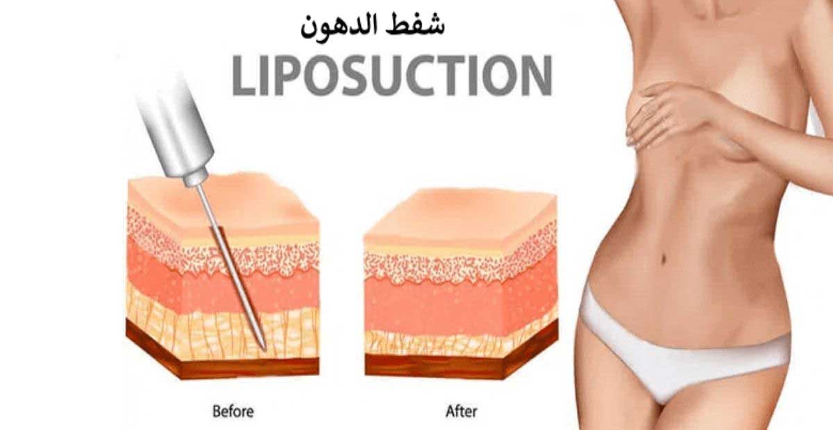 liposuction-in-egypt