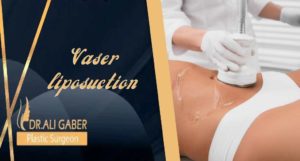 Read more about the article Vaser Liposuction in Egypt