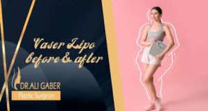 Read more about the article Vaser Lipo before and after