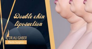 Read more about the article Double chin liposuction surgery procedure and recovery