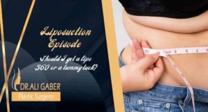 Read more about the article Liposuction Episode: Should I get a lipo 360 or a tummy tuck?