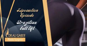 Read more about the article What is the Brazilian butt lift? | Liposuction episode