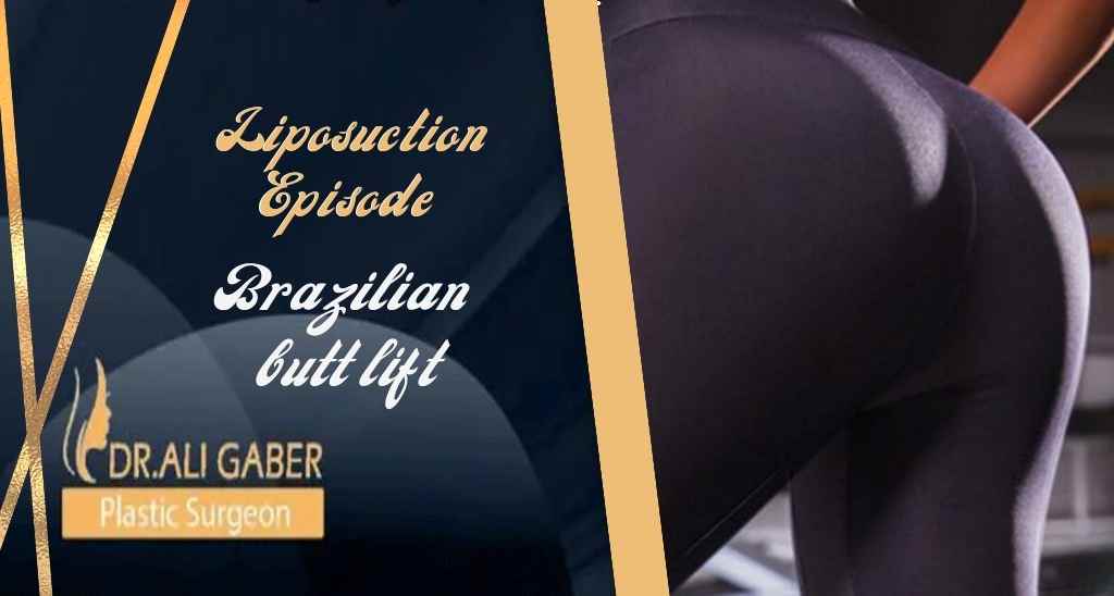 What is the Brazilian butt lift? | Liposuction episode