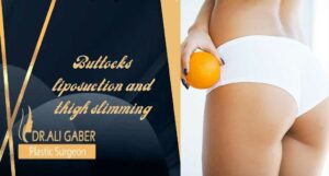 Read more about the article Buttocks liposuction and thigh slimming