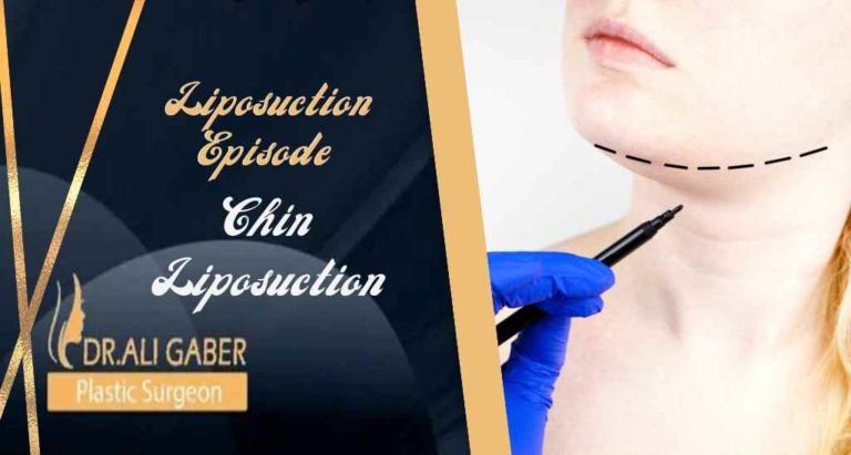 Read more about the article Double chin liposuction, Can fat cells return?