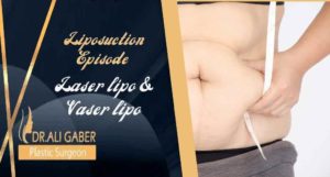 Read more about the article Differences between laser lipo, vaser liposuction