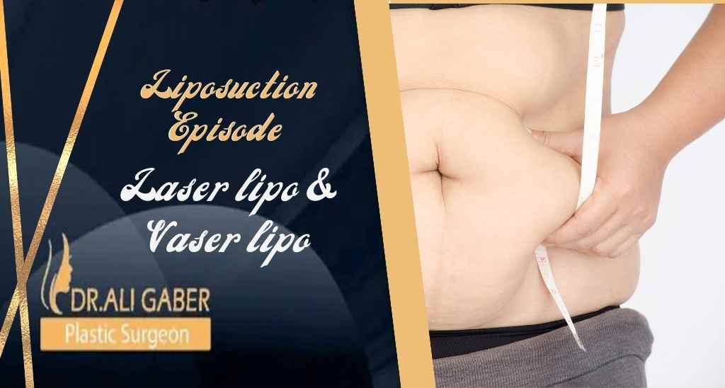 Differences between laser lipo, vaser liposuction