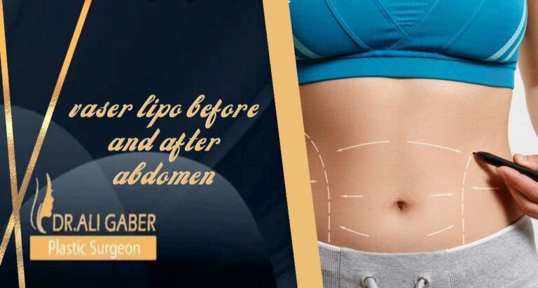 Read more about the article vaser lipo before and after abdomen