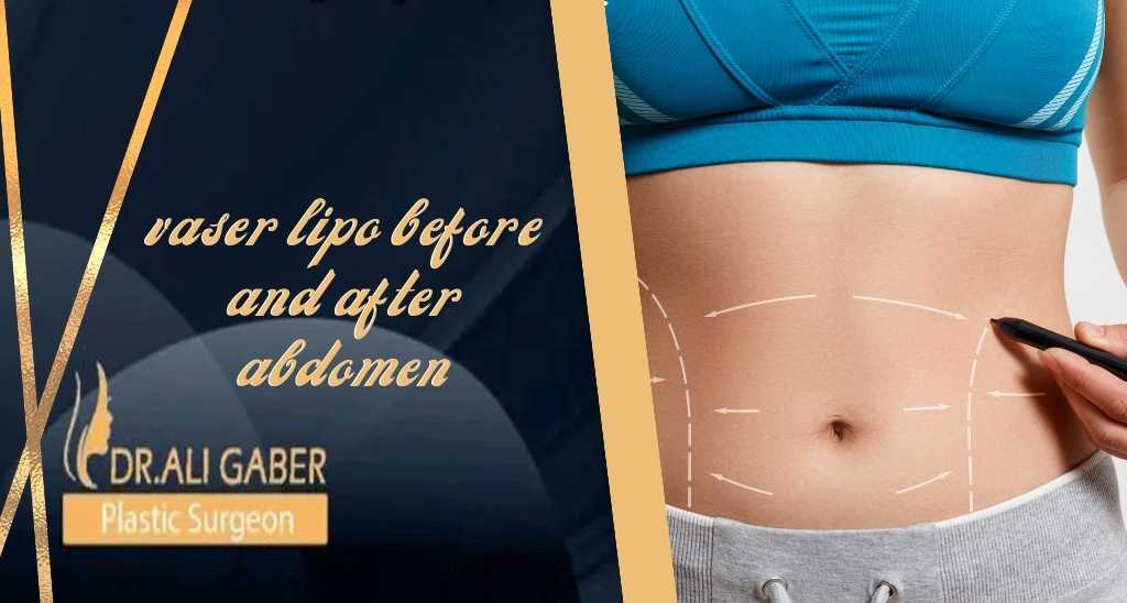 vaser lipo before and after abdomen