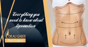 Read more about the article Everything you need to know about liposuction