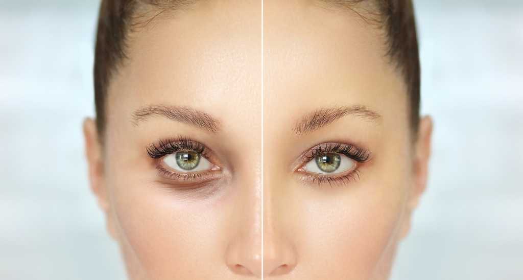 How much does eyelid surgery cost in Egypt
