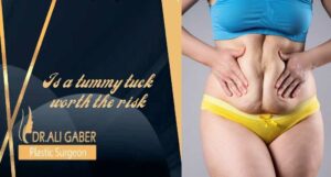 Read more about the article Is a tummy tuck worth the risk?
