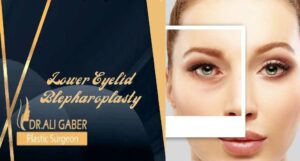 Read more about the article Lower Eyelid Blepharoplasty