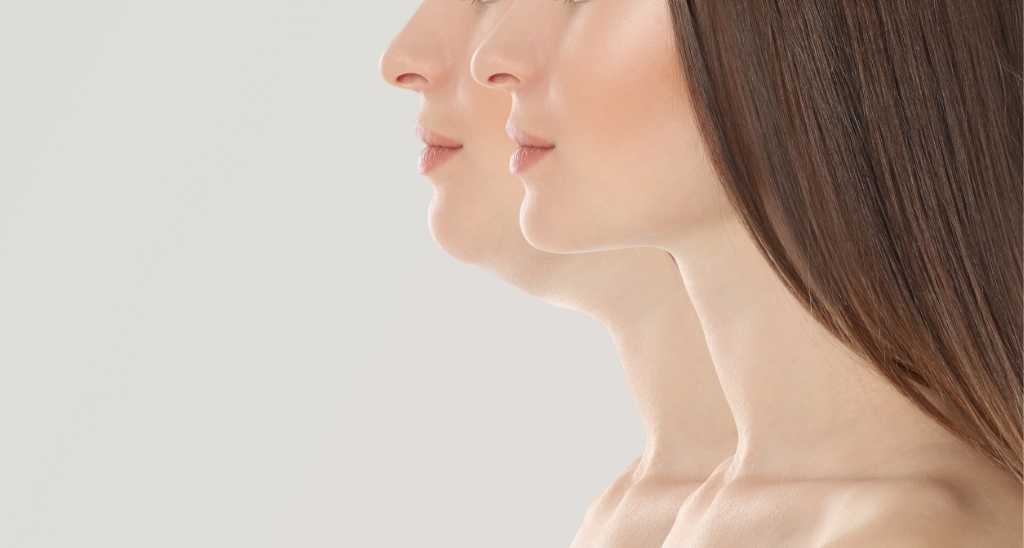 Liposuction in Egypt Double Chin Liposuction
