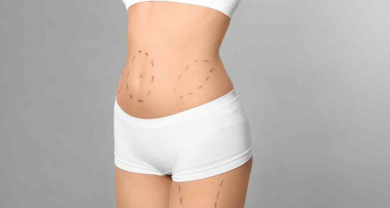 Liposuction in Egypt Prices
