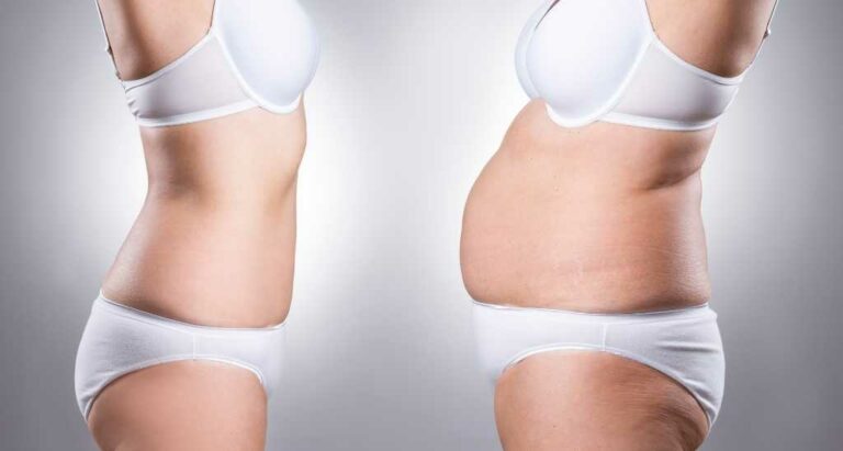 Liposuction in Egypt Prices