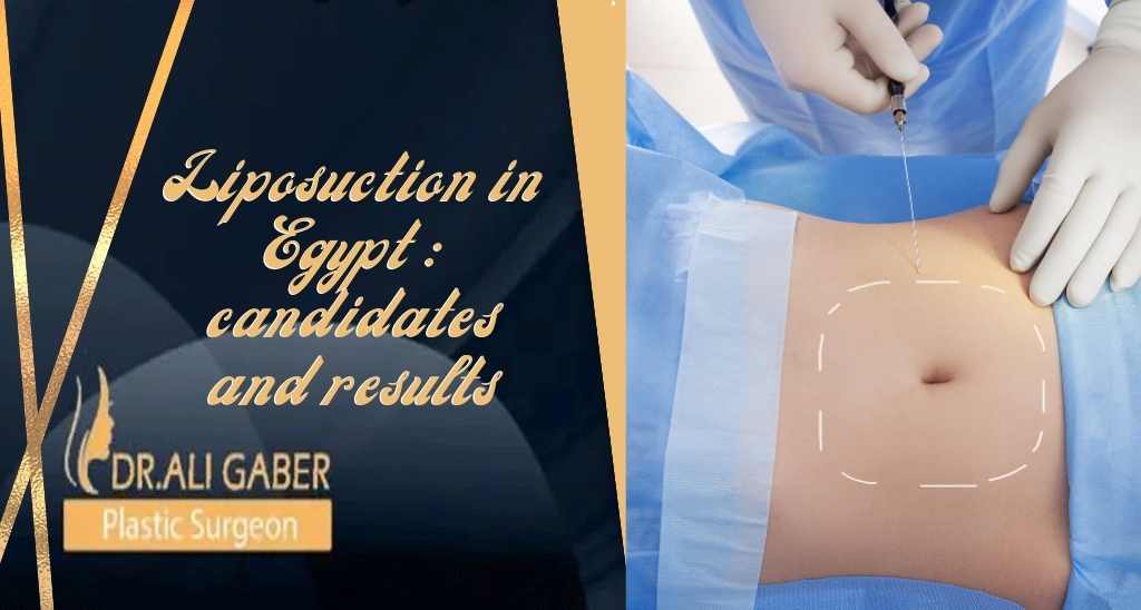 Liposuction in Egypt candidates and results