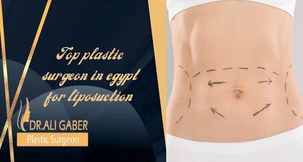 Top plastic surgeon in Egypt for liposuction