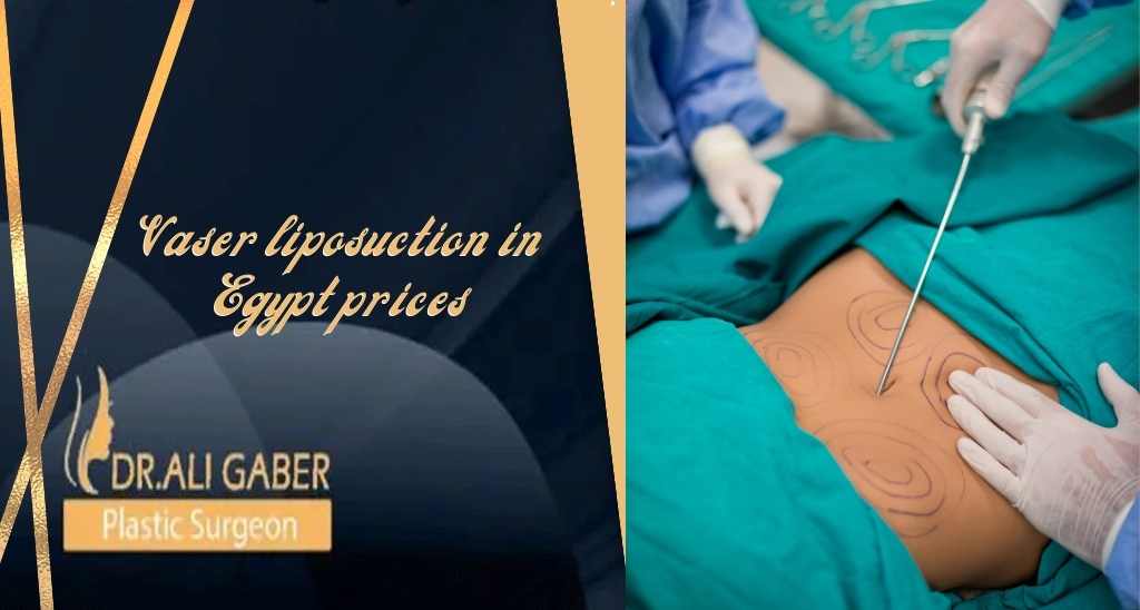 Vaser liposuction in Egypt prices