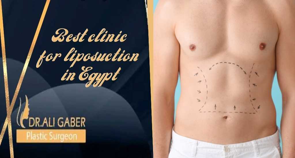 You are currently viewing Best clinic for liposuction in Egypt