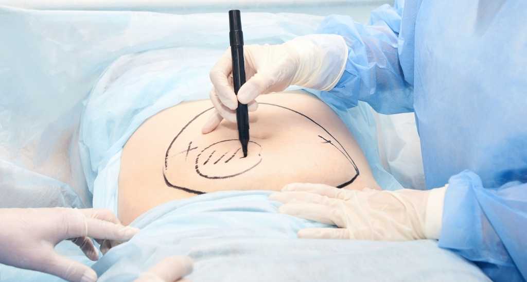Best clinic for liposuction in Egypt