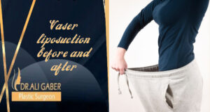 Read more about the article Vaser liposuction before and after