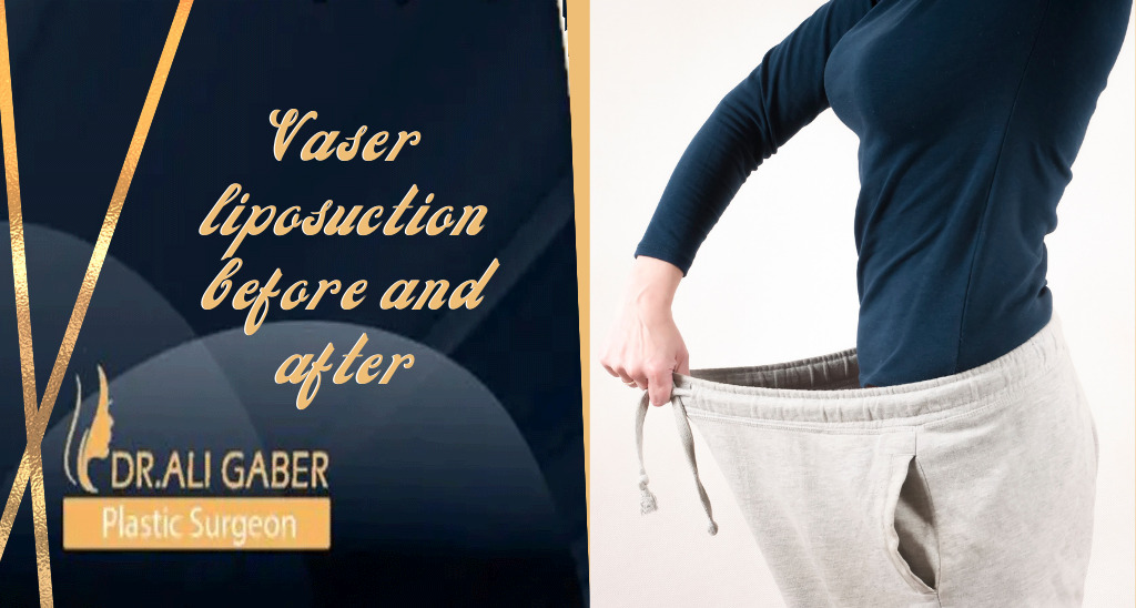 You are currently viewing Vaser liposuction before and after