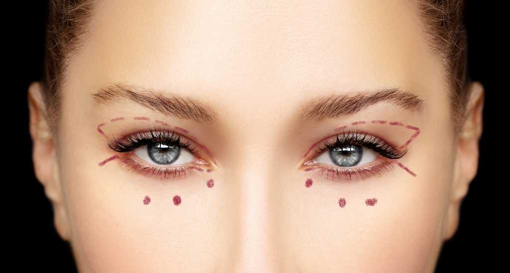 What is double eyelid surgery?