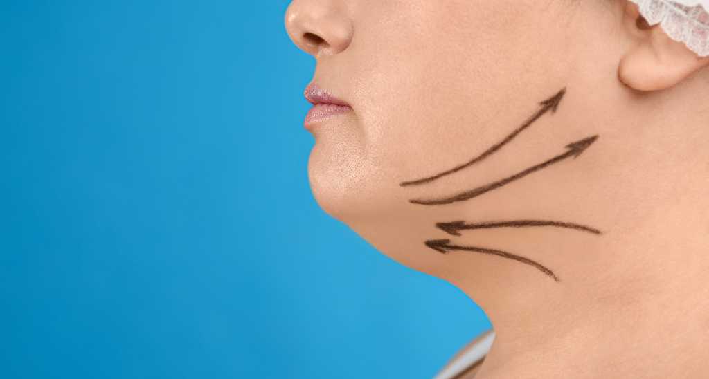 Double chin liposuction in Egypt Cost and results