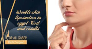 Read more about the article Double chin liposuction in Egypt: Cost and results