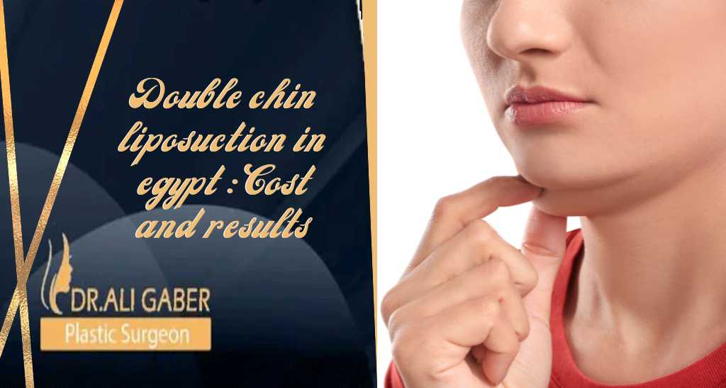 Double chin liposuction in Egypt: Cost and results