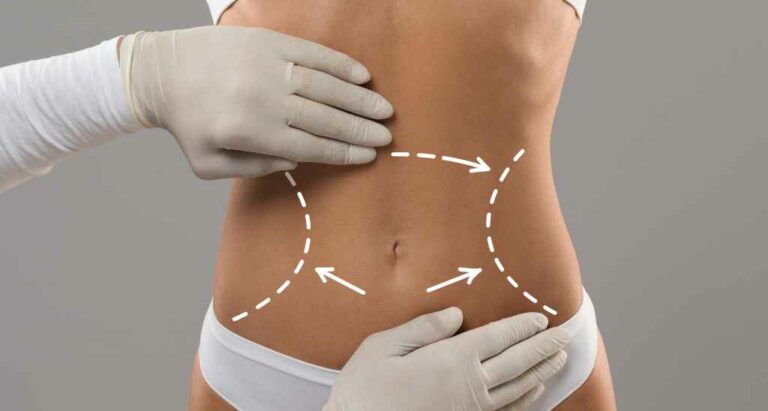 Vaser Liposuction Everything You Need to Know